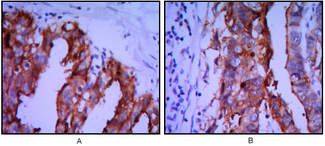 PLAP / Alkaline Phosphatase Antibody - IHC of paraffin-embedded ovarian cancer (A), stomach cancer (B) using ALPP mouse monoclonal antibody with DAB staining.