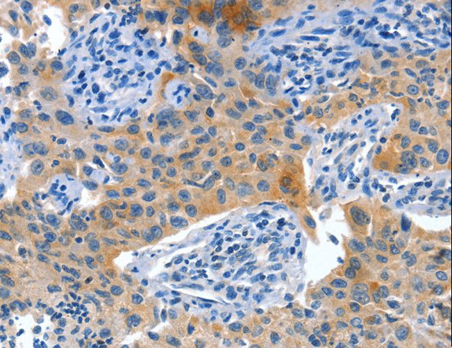 PLAP / Alkaline Phosphatase Antibody - Immunohistochemistry of paraffin-embedded Human lung cancer using ALPP Polyclonal Antibody at dilution of 1:60.