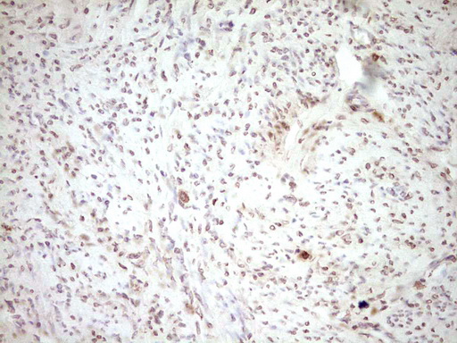 PLAT / TPA Antibody - Immunohistochemical staining of paraffin-embedded Adenocarcinoma of Human endometrium tissue using anti-PLAT mouse monoclonal antibody. (Heat-induced epitope retrieval by 1 mM EDTA in 10mM Tris, pH8.5, 120C for 3min,