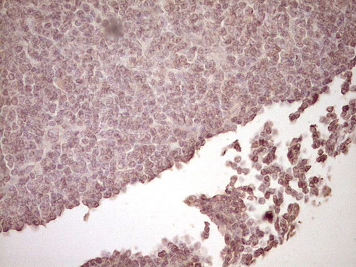 PLAT / TPA Antibody - Immunohistochemical staining of paraffin-embedded Human lymphoma tissue using anti-PLAT mouse monoclonal antibody. (Heat-induced epitope retrieval by 1 mM EDTA in 10mM Tris, pH8.5, 120C for 3min,