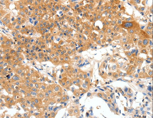 PLAT / TPA Antibody - Immunohistochemistry of paraffin-embedded Human lung cancer using PLAT Polyclonal Antibody at dilution of 1:50.