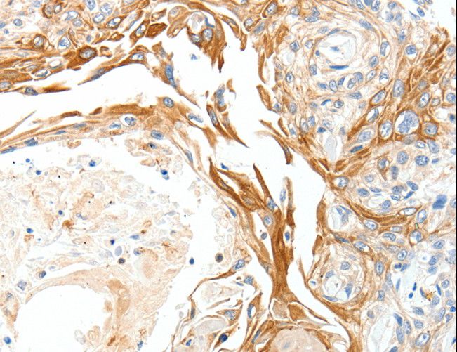 PLAT / TPA Antibody - Immunohistochemistry of paraffin-embedded Human esophagus cancer using PLAT Polyclonal Antibody at dilution of 1:50.