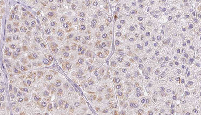 PLAT / TPA Antibody - 1:100 staining human Melanoma tissue by IHC-P. The sample was formaldehyde fixed and a heat mediated antigen retrieval step in citrate buffer was performed. The sample was then blocked and incubated with the antibody for 1.5 hours at 22°C. An HRP conjugated goat anti-rabbit antibody was used as the secondary.