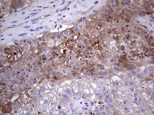 PLAU / Urokinase / uPA Antibody - Immunohistochemical staining of paraffin-embedded Carcinoma of Human lung tissue using anti-PLAU mouse monoclonal antibody. (Heat-induced epitope retrieval by 1 mM EDTA in 10mM Tris, pH8.5, 120C for 3min,