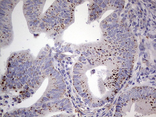 PLAU / Urokinase / uPA Antibody - Immunohistochemical staining of paraffin-embedded Adenocarcinoma of Human colon tissue using anti-PLAU mouse monoclonal antibody. (Heat-induced epitope retrieval by 1 mM EDTA in 10mM Tris, pH8.5, 120C for 3min,