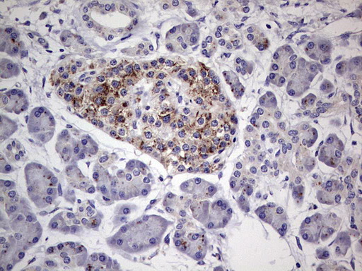 PLAU / Urokinase / uPA Antibody - IHC of paraffin-embedded Carcinoma of Human pancreas tissue using anti-PLAU mouse monoclonal antibody. (Heat-induced epitope retrieval by 1 mM EDTA in 10mM Tris, pH8.5, 120°C for 3min).
