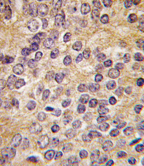 PLAU / Urokinase / uPA Antibody - Formalin-fixed and paraffin-embedded human prostate carcinoma tissue reacted with PLAU antibody (C-term ), which was peroxidase-conjugated to the secondary antibody, followed by DAB staining. This data demonstrates the use of this antibody for immunohistochemistry; clinical relevance has not been evaluated.