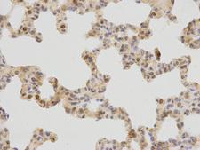 PLCB1 / Phospholipase C Beta 1 Antibody - Immunohistochemistry of paraffin-embedded human breast cancer using PLCB1 antibody at dilution of 1:200 (400x lens).