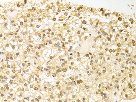 PLCB1 / Phospholipase C Beta 1 Antibody - Immunohistochemistry of paraffin-embedded human kidney cancer tissue.