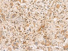PLCB2 Antibody - Immunohistochemistry of paraffin-embedded Human liver cancer tissue  using PLCB2 Polyclonal Antibody at dilution of 1:60(×200)