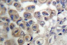 PLCB3 Antibody - IHC of PLC 3 (L532) pAb in paraffin-embedded human breast carcinoma tissue.