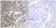 PLCB3 Antibody - Peptide - + Immunohistochemistry analysis of paraffin-embedded human breast carcinoma tissue using PLC ß3 antibody.