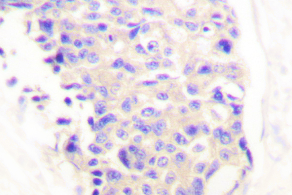 PLCG1 Antibody - IHC of PLC 1 (G765) pAb in paraffin-embedded human breast carcinoma tissue.