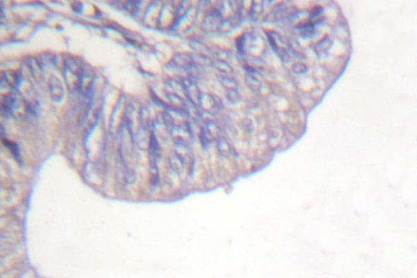 PLCG1 Antibody - IHC of PLCG1 (G777) pAb in paraffin-embedded human breast carcinoma tissue.