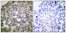 PLCG1 Antibody - Peptide - + Immunohistochemical analysis of paraffin-embedded human breast carcinoma tissue using PLCG1 (Ab-771) antibody.