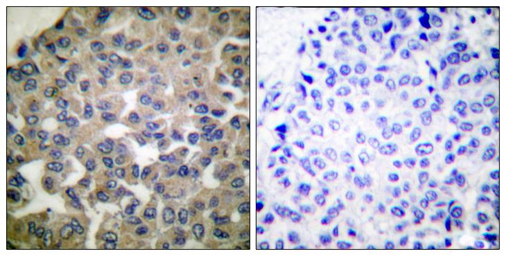 PLCG1 Antibody - Peptide - + Immunohistochemical analysis of paraffin-embedded human breast carcinoma tissue using PLCG1 (Ab-771) antibody.