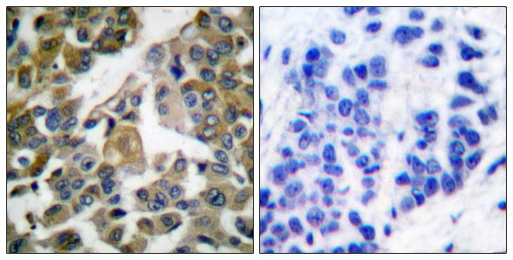 PLCG1 Antibody - Peptide - + Immunohistochemical analysis of paraffin-embedded human breast carcinoma tissue using PLCG1 (Ab-783) antibody.
