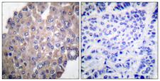 PLCG1 Antibody - Immunohistochemistry analysis of paraffin-embedded human breast carcinoma, using PLCG1 (Phospho-Tyr771) Antibody. The picture on the right is blocked with the phospho peptide.