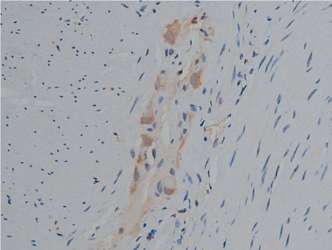 PLCG1 Antibody - 1:50 staining human colon carcinoma tissue by IHC-P. The tissue was formaldehyde fixed and a heat mediated antigen retrieval step in citrate buffer was performed. The tissue was then blocked and incubated with the antibody for 1.5 hours at 22°C. An HRP conjugated goat anti-rabbit antibody was used as the secondary.