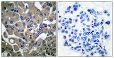 PLCG1 Antibody - Immunohistochemistry analysis of paraffin-embedded human breast carcinoma, using PLCG1 (Phospho-Tyr783) Antibody. The picture on the right is blocked with the phospho peptide.