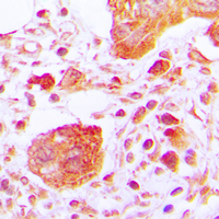 PLCG1 Antibody - Immunohistochemical analysis of PLC gamma 1 (pY783) staining in human lung cancer formalin fixed paraffin embedded tissue section. The section was pre-treated using heat mediated antigen retrieval with sodium citrate buffer (pH 6.0). The section was then incubated with the antibody at room temperature and detected using an HRP conjugated compact polymer system. DAB was used as the chromogen. The section was then counterstained with hematoxylin and mounted with DPX.