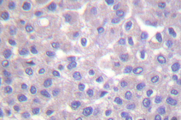 PLCG2 / PLC Gamma 2 Antibody - IHC of PLCG2 (R747) pAb in paraffin-embedded human breast carcinoma tissue.