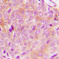 PLCG2 / PLC Gamma 2 Antibody - Immunohistochemical analysis of PLC gamma 2 staining in human breast cancer formalin fixed paraffin embedded tissue section. The section was pre-treated using heat mediated antigen retrieval with sodium citrate buffer (pH 6.0). The section was then incubated with the antibody at room temperature and detected using an HRP conjugated compact polymer system. DAB was used as the chromogen. The section was then counterstained with hematoxylin and mounted with DPX.