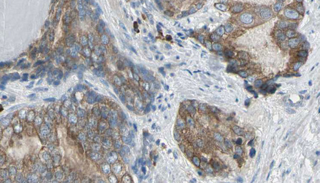 PLCG2 / PLC Gamma 2 Antibody - 1:100 staining human prostate tissue by IHC-P. The sample was formaldehyde fixed and a heat mediated antigen retrieval step in citrate buffer was performed. The sample was then blocked and incubated with the antibody for 1.5 hours at 22°C. An HRP conjugated goat anti-rabbit antibody was used as the secondary.