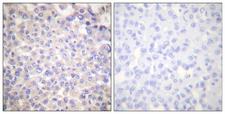 PLCG2 / PLC Gamma 2 Antibody - Peptide - + Immunohistochemical analysis of paraffin-embedded human breast carcinoma tissue using PLCG2 (Ab-753) antibody.