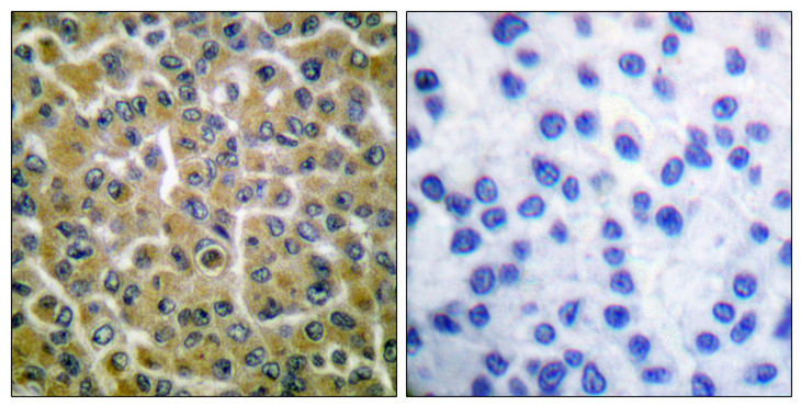 PLCG2 / PLC Gamma 2 Antibody - Immunohistochemistry analysis of paraffin-embedded human breast carcinoma, using PLCG2 (Phospho-Tyr753) Antibody. The picture on the right is blocked with the phospho peptide.