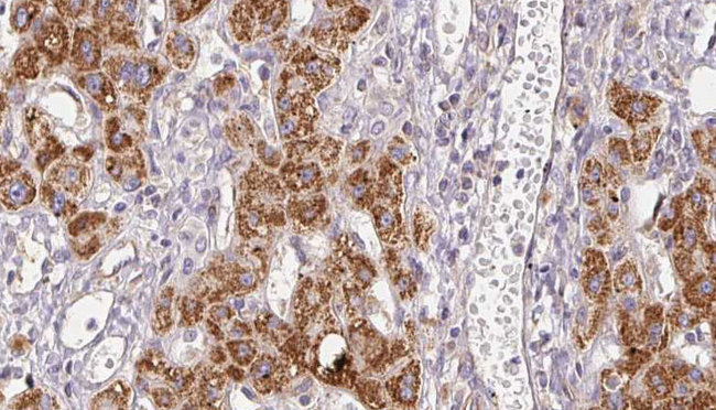 PLCH2 Antibody - 1:100 staining human liver carcinoma tissues by IHC-P. The sample was formaldehyde fixed and a heat mediated antigen retrieval step in citrate buffer was performed. The sample was then blocked and incubated with the antibody for 1.5 hours at 22°C. An HRP conjugated goat anti-rabbit antibody was used as the secondary.