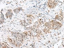 PLCL2 Antibody - Immunohistochemistry of paraffin-embedded Human esophagus cancer tissue  using PLCL2 Polyclonal Antibody at dilution of 1:50(×200)