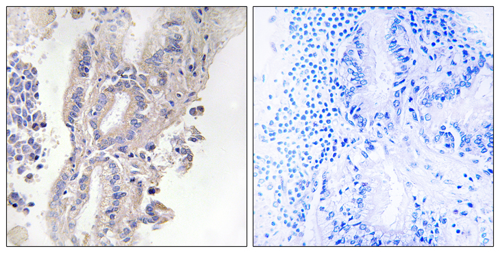 PLCXD1 Antibody - Immunohistochemistry analysis of paraffin-embedded human lung carcinoma, using PLCXD1 Antibody. The picture on the right is blocked with the synthesized peptide.