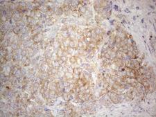 PLCXD1 Antibody - Immunohistochemical staining of paraffin-embedded Adenocarcinoma of Human endometrium tissue using anti-PLCXD1 mouse monoclonal antibody. (Heat-induced epitope retrieval by 1mM EDTA in 10mM Tris buffer. (pH8.5) at 120°C for 3 min. (1:150)