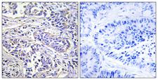 PLCXD1 Antibody - Peptide - + Immunohistochemistry analysis of paraffin-embedded human lung carcinoma tissue using PLCXD1 antibody.