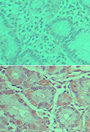 PLD2 / Phospholipase D2 Antibody - IHC of PLD2 in formalin-fixed, paraffin-embedded human stomach tissue using preimmune sera (top) and Polyclonal Antibody to PLD2 (bottom) at 1:50.
