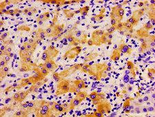 PLD2 / Phospholipase D2 Antibody - Immunohistochemistry image of paraffin-embedded human liver cancer at a dilution of 1:100