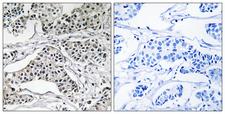 PLD3 / Phospholipase D3 Antibody - Peptide - + Immunohistochemistry analysis of paraffin-embedded human breast carcinoma tissue using PLD3 antibody.