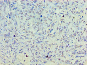 PLD5 / Phospholipase D5 Antibody - Immunohistochemistry of paraffin-embedded human breast cancer using PLD5 Antibody at dilution of 1:100
