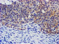 PLDN / Pallidin Antibody - IHC of paraffin-embedded Adenocarcinoma of Human ovary tissue using anti-PLDN mouse monoclonal antibody. (Heat-induced epitope retrieval by 10mM citric buffer, pH6.0, 100C for 10min).