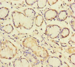 PLDN / Pallidin Antibody - Immunohistochemistry of paraffin-embedded human gastric cancer at dilution of 1:100