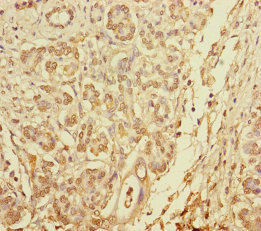 PLDN / Pallidin Antibody - Immunohistochemistry of paraffin-embedded human pancreatic cancer at dilution of 1:100