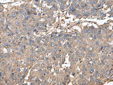 PLDN / Pallidin Antibody - Immunohistochemistry of paraffin-embedded Human liver cancer tissue  using BLOC1S6 Polyclonal Antibody at dilution of 1:95(×200)