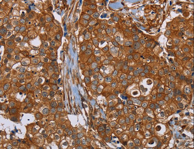 PLEC / Plectin Antibody - Immunohistochemistry of paraffin-embedded Human breast cancer using PLEC Polyclonal Antibody at dilution of 1:40.