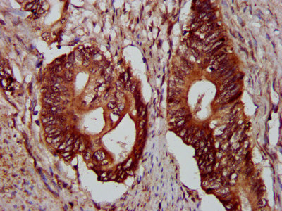 PLEC / Plectin Antibody - Immunohistochemistry image at a dilution of 1:300 and staining in paraffin-embedded human colon cancer performed on a Leica BondTM system. After dewaxing and hydration, antigen retrieval was mediated by high pressure in a citrate buffer (pH 6.0) . Section was blocked with 10% normal goat serum 30min at RT. Then primary antibody (1% BSA) was incubated at 4 °C overnight. The primary is detected by a biotinylated secondary antibody and visualized using an HRP conjugated SP system.