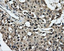 PLEK / Pleckstrin Antibody - IHC of paraffin-embedded Adenocarcinoma of breast tissue using anti-PLEK mouse monoclonal antibody. (Dilution 1:50).
