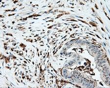 PLEK / Pleckstrin Antibody - IHC of paraffin-embedded Adenocarcinoma of colon tissue using anti-PLEK mouse monoclonal antibody. (Dilution 1:50).