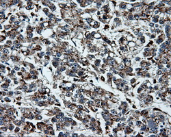 PLEK / Pleckstrin Antibody - IHC of paraffin-embedded Carcinoma of liver tissue using anti-PLEK mouse monoclonal antibody. (Dilution 1:50).