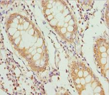 PLEKHA1 Antibody - Immunohistochemistry of paraffin-embedded human colon cancer at dilution 1:100