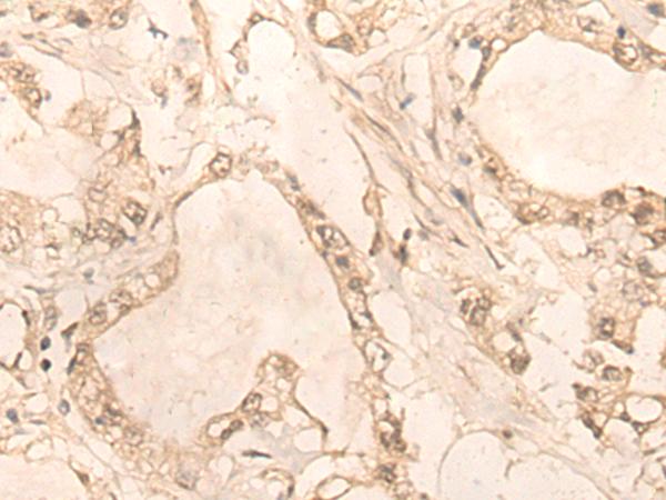 PLEKHA1 Antibody - Immunohistochemistry of paraffin-embedded Human gastric cancer tissue  using PLEKHA1 Polyclonal Antibody at dilution of 1:30(×200)